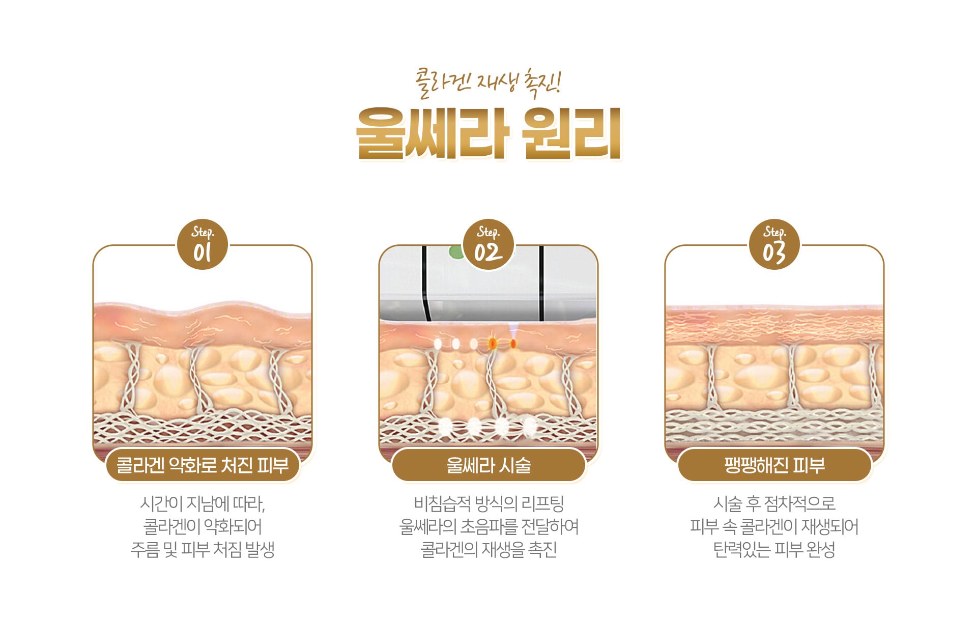 울쎄라 원리 천안피부과 닥터에버스