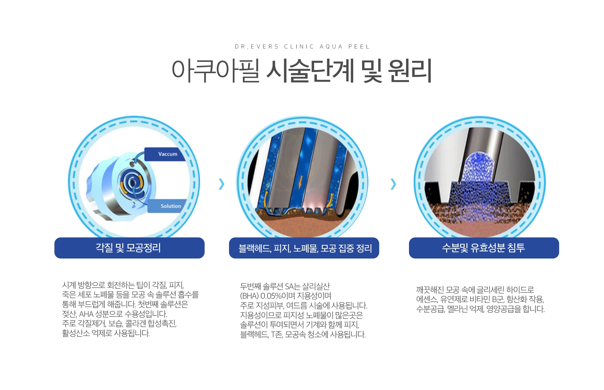 아쿠아필 스케일링 원리 천안피부과 닥터에버스